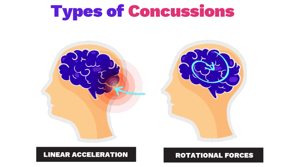 types of Concussions