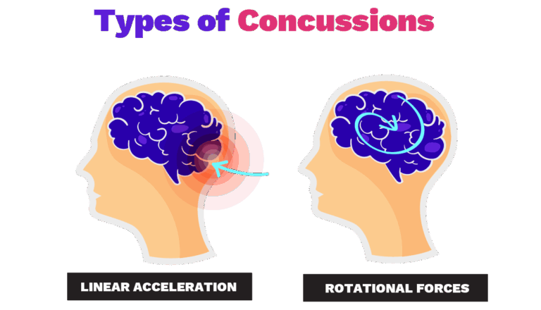 types of Concussions