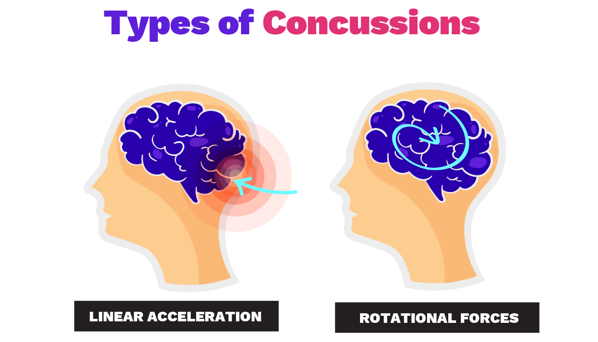 types of Concussions